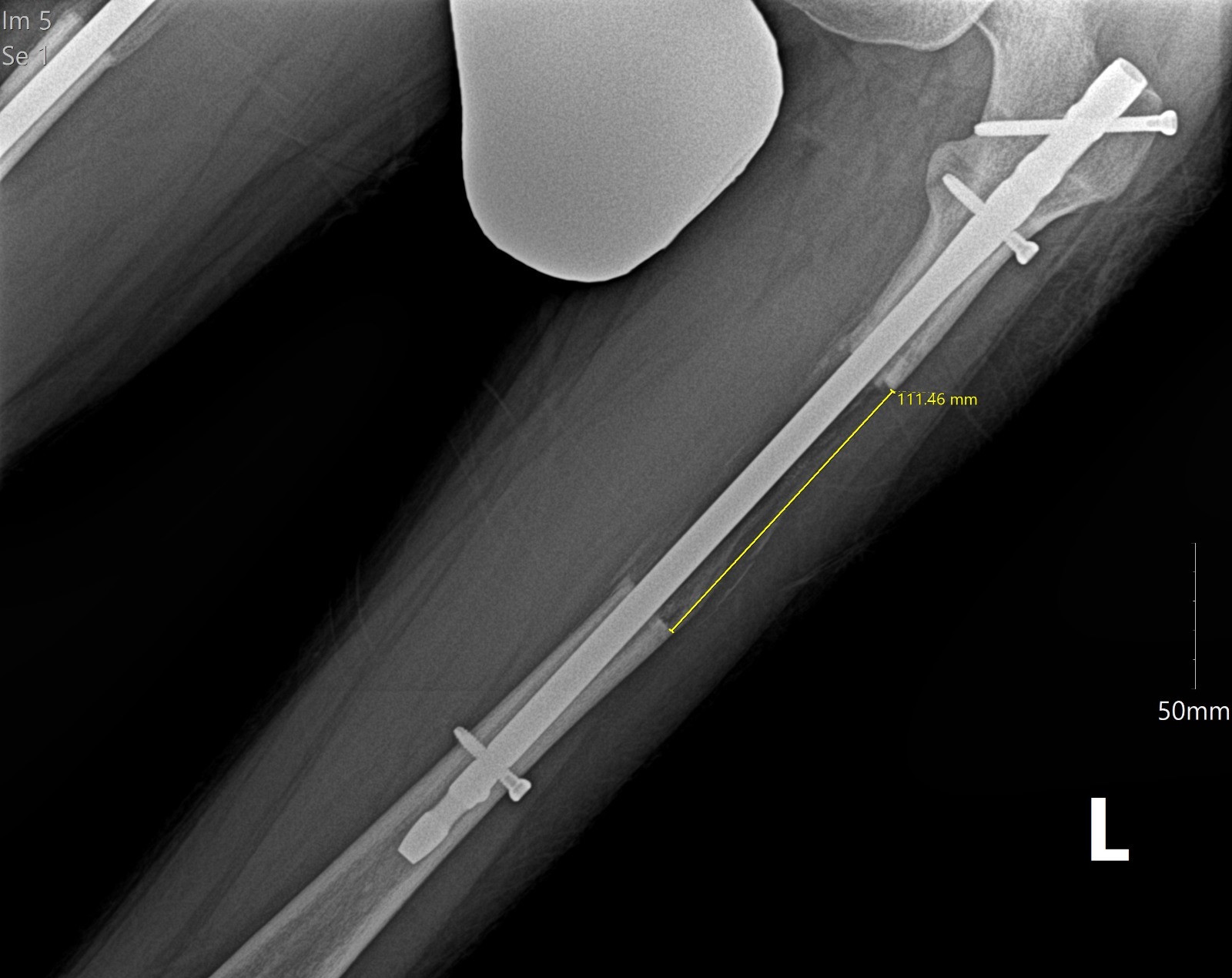 Lucas’s selected left X-ray, retaining the original yellow 111.46 mm annotation.