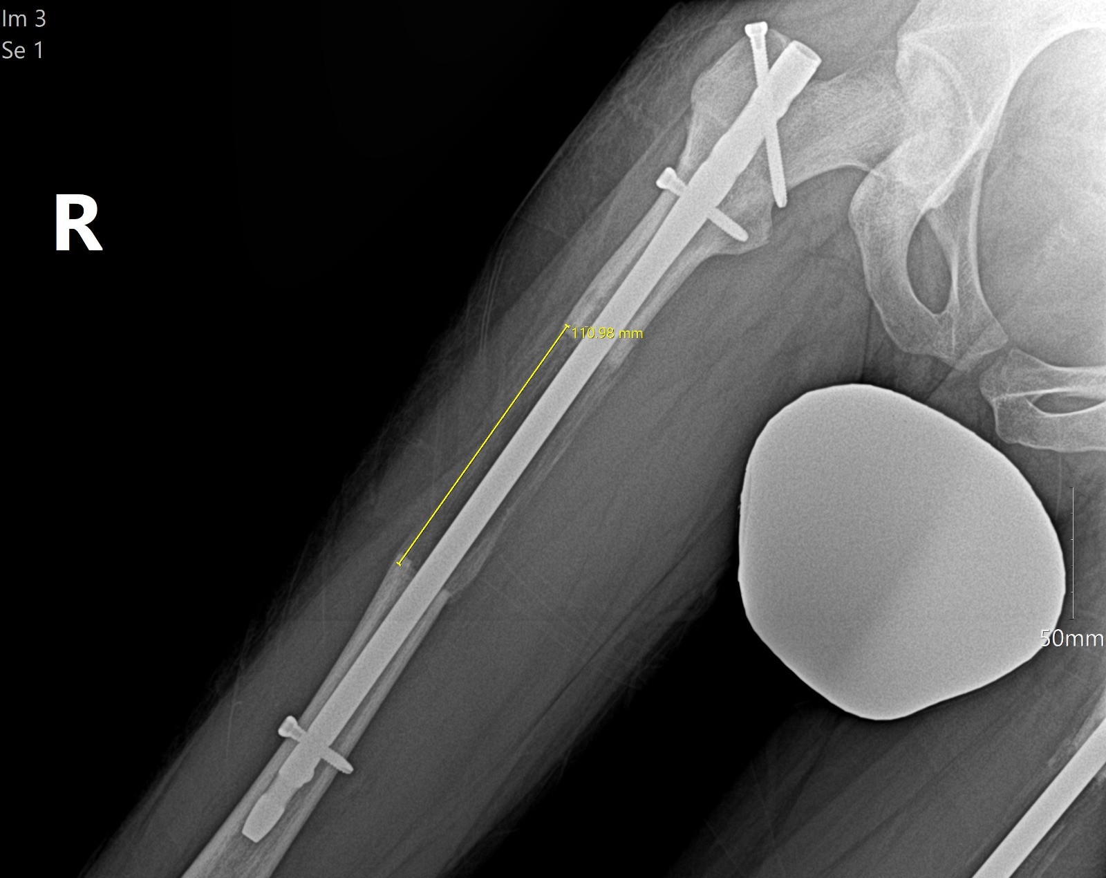 Lucas’s selected right X-ray, retaining the original yellow 110.98 mm annotation.